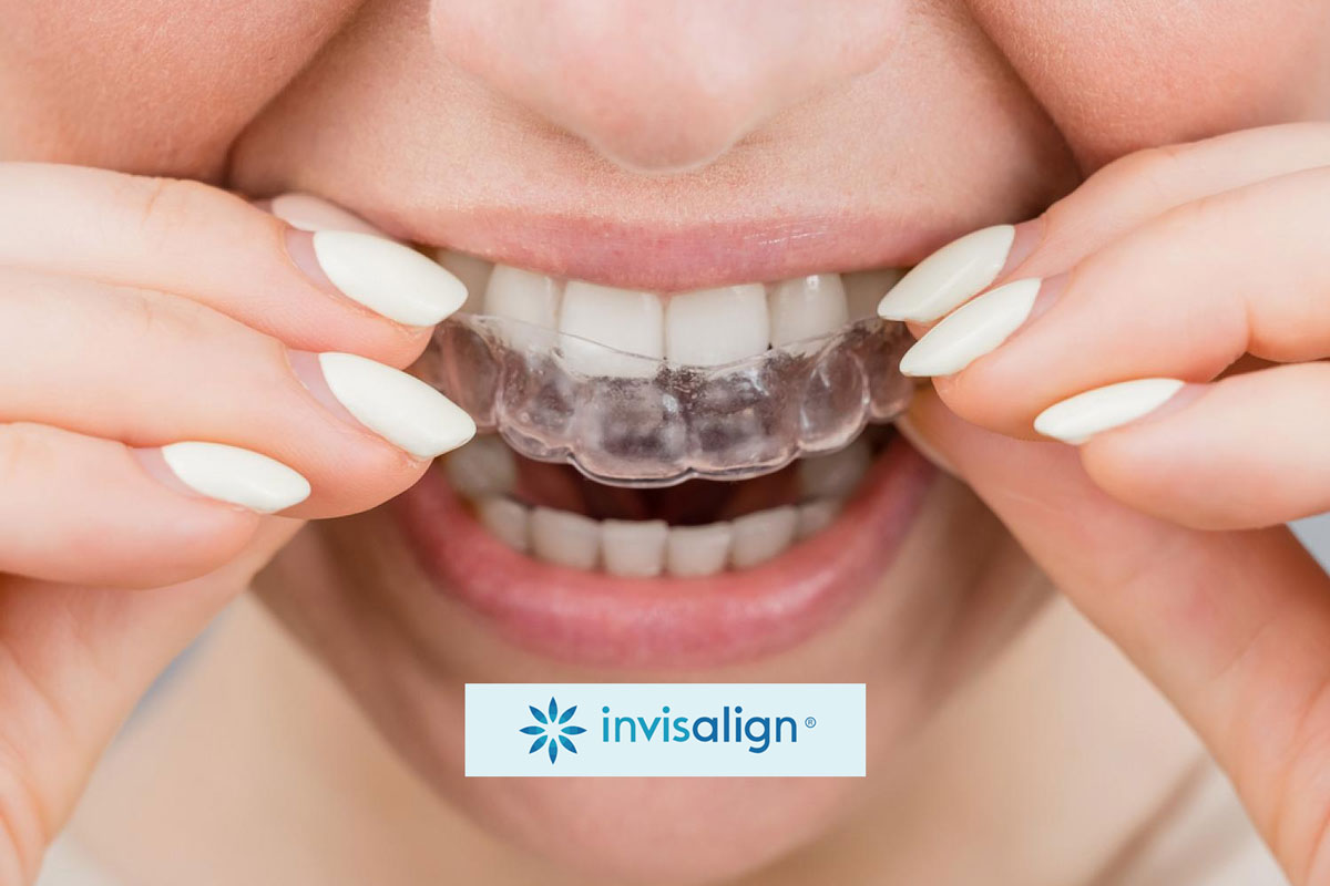 Invisalign Aligners